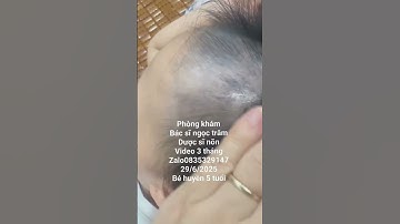 rụng tóc mảng. bé huyền 5 tuổi. video 3 tháng #toctoc