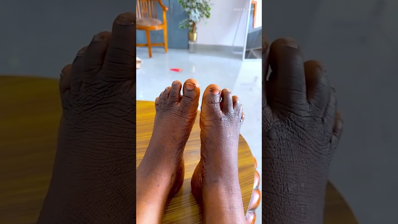 Трансформации пальцев ног