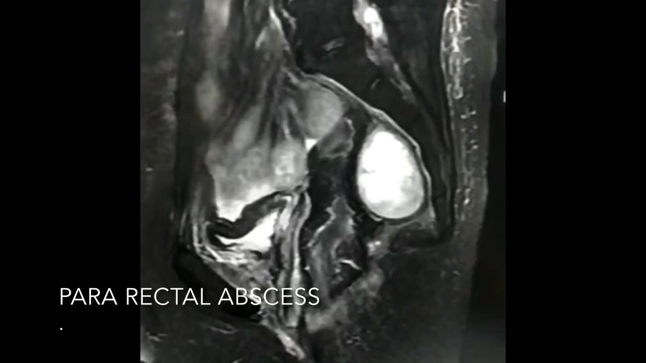 EUS guided para rectal abscess drainage YouTube