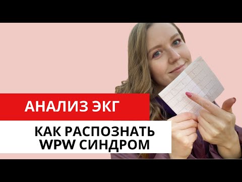 ЭКГ диагностика WPW-синдрома (синдром Вольфа — Паркинсона — Уайта). Синдромы предвозбуждения.