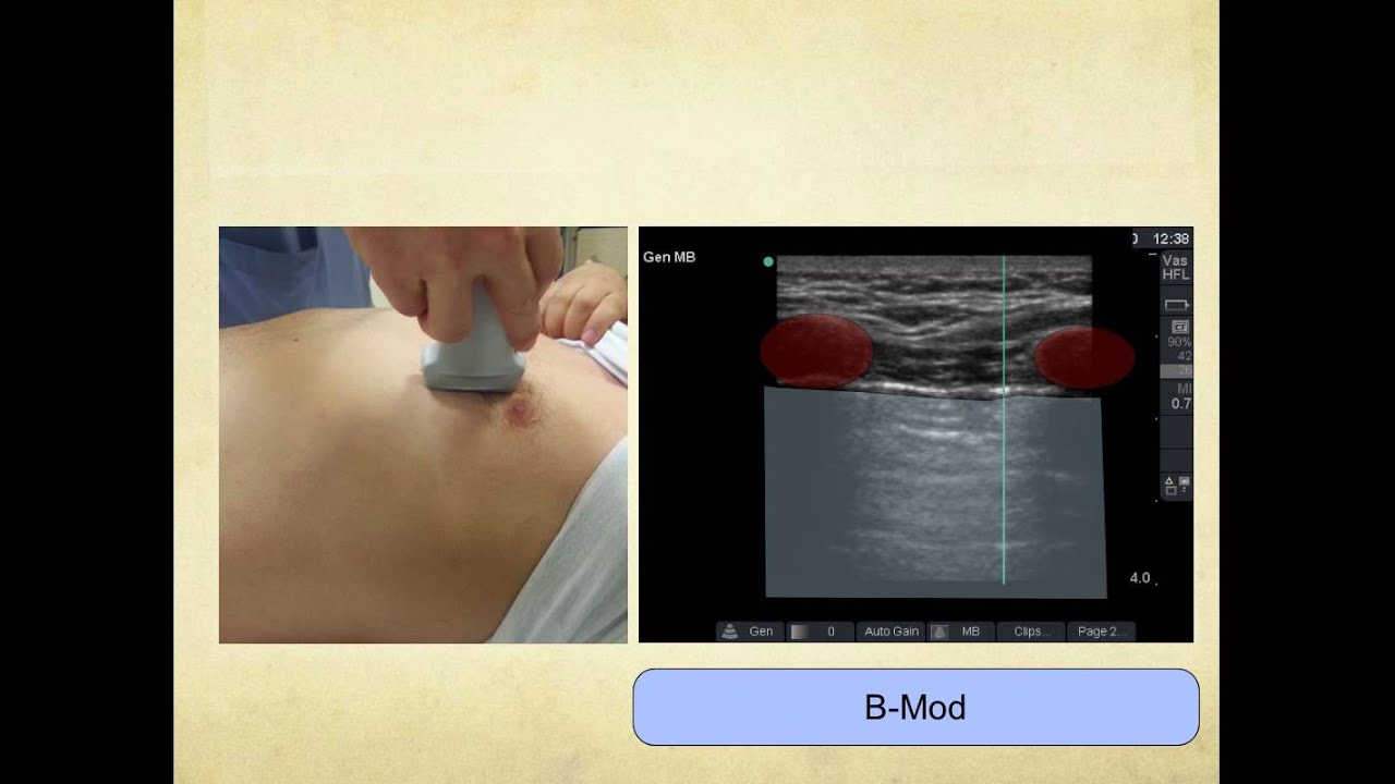 Acil Serviste Pnömotoraks tanısında USG