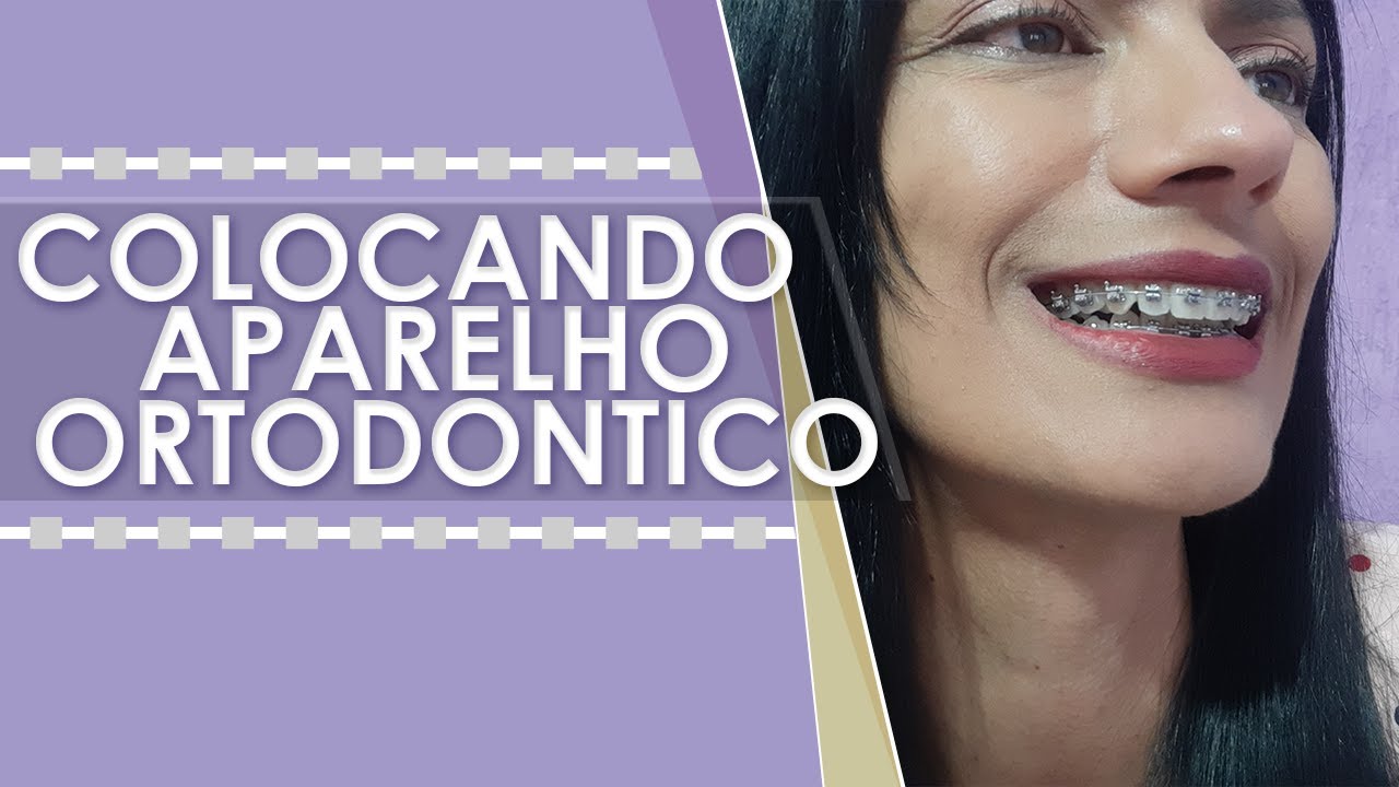 Coloquei aparelho ortodôntico