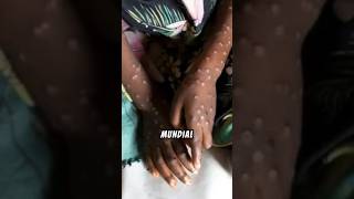 OMS DECLARA EMERGENCIA SANITATIA POR BROTE DE MPOX #oms #noticia #emergencia #fyp