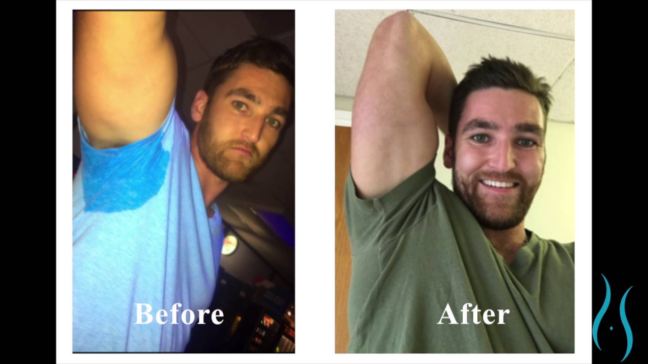 miraDry Treatment for Hyperhidrosis (Excessive Sweating) in Connecticut