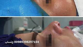 تجميل الانف دكتور كامران كاوياني فر / جراحة تجميل الانف 00989398297154