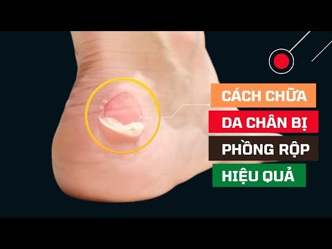 Video: 4 cách điều trị phồng rộp chân