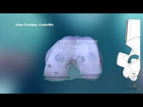 3D Knee Replacement