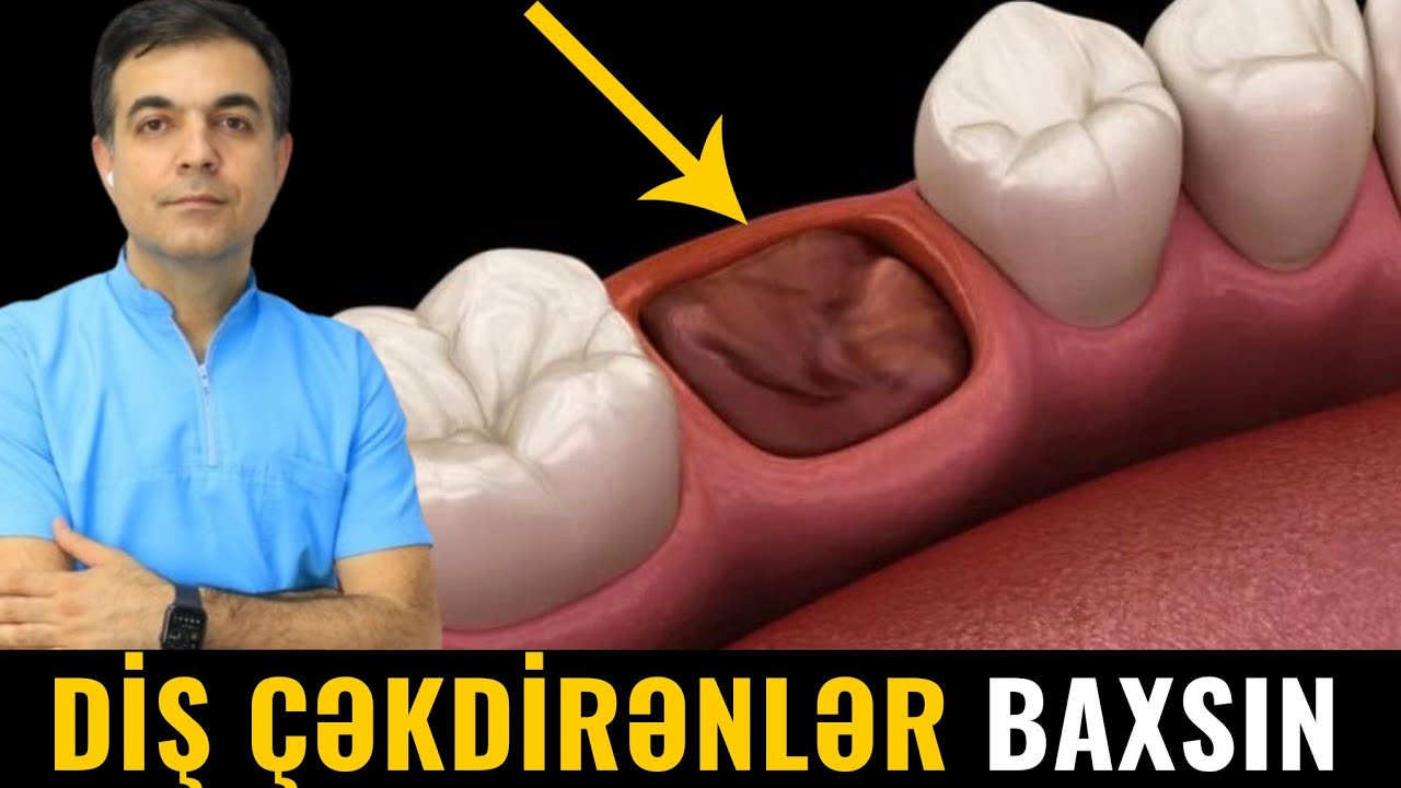 Diş çəkildikdən sonra YARAYA QULLUQ - Bunları mütləq edin!