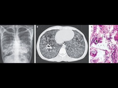 Video: Pulmonale Und Pleurale Lymphatische Endothelzellen Von Pädiatrischen, Aber Nicht Erwachsenen Patienten Mit Gorham-Stout-Krankheit Und Generalisierter Lymphatischer Anomalie Zeigen