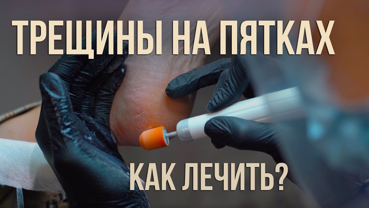 Как убрать трещины на стопах - YouTube