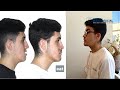 Bimaxillary Surgery | Case #149: |Manuel- Class III, long face