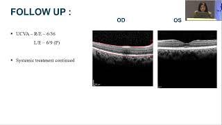 Aios2025 Aios Pg Capsule 6 T Dr Priyanka Mohanty From Eye To System Lupus Retinopathy In New Sle