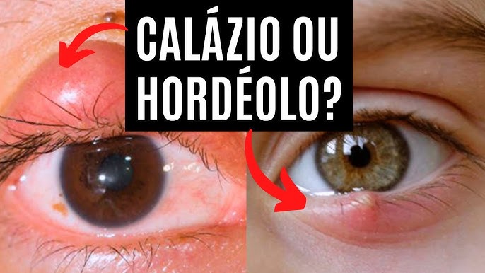 Hordéolo ou Terçol - O que é? 