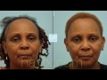 African-American Corrective Hair Transplant Close-Up Video of Result & Incision