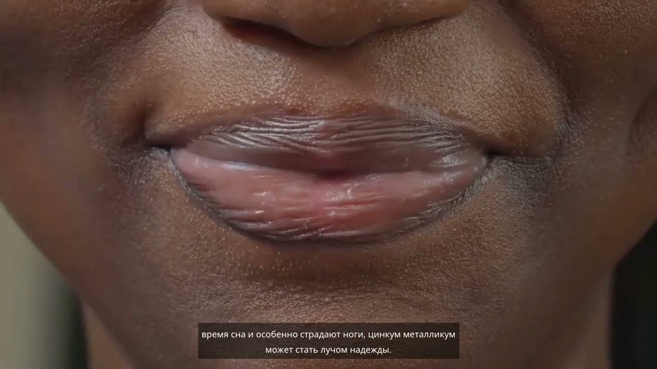 Изучите Цинкум Металликум | Скачайте Приложение HomeoMonk