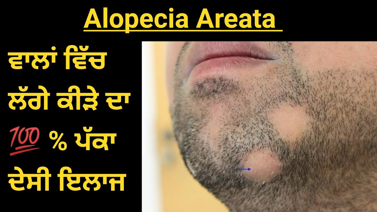  NewVideo  HairFall  Best Home Remedy For Hair loss By Alopecia Areata      