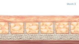 How the Ultherapy Treatment Works
