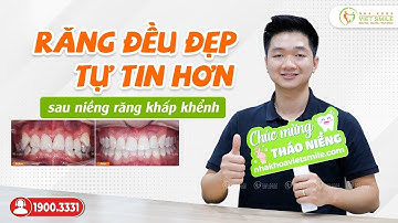 Nụ cười tự tin sau niềng răng khấp khểnh - Dương Văn Phụng CG717