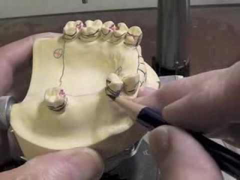 R P D Design - Ken Class III Max Dentoform Cast Part D 