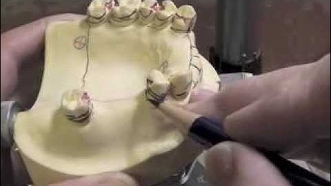 R P D Design - Ken Class III Max Dentoform Cast Part D