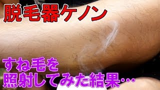 ケノンですね毛を照射 ２種のカートリッジでケノンの脱毛力を比較測定