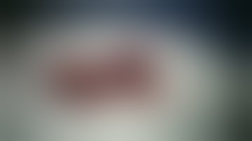 Double Circular Stapler for Rectosigmoid Endometriosis