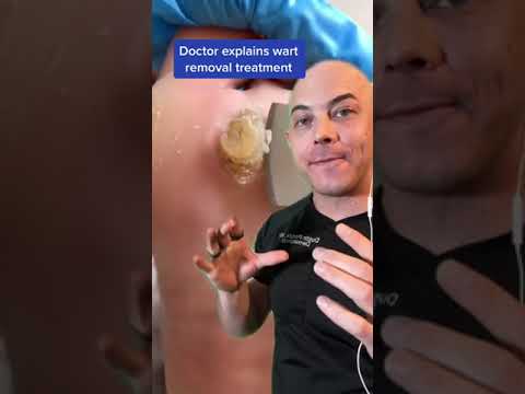 Derm explains massive foot calluses! #dermreacts #doctorreacts #calluses #warts