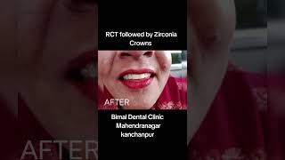 CASE 1 : RCT F/w Zirconia Crowns (Bimal Dental Clinic)