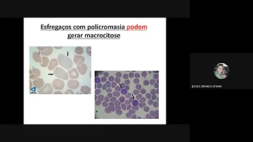 O que é macrocitose no sangue?