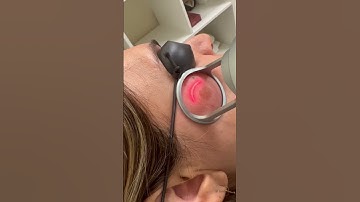 Thumbnail of Fractional Co2 laser for pigmentation