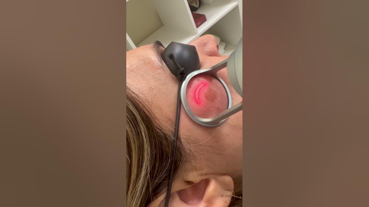 Fractional Co2 laser for pigmentation