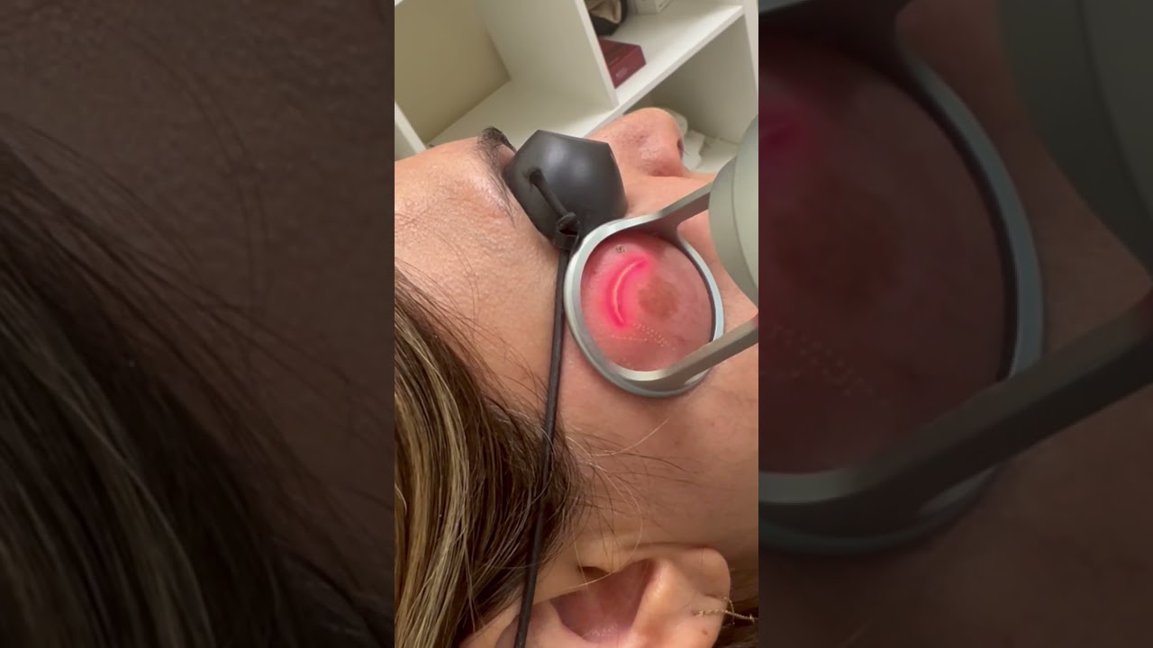 Fractional Co2 laser for pigmentation