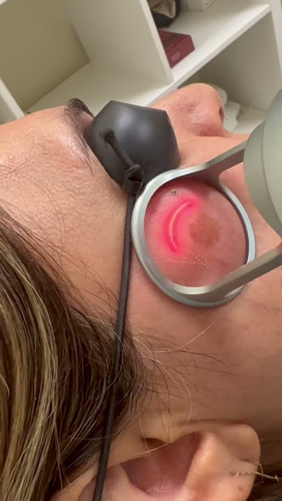 Laser fraksional Co2 untuk pigmentasi