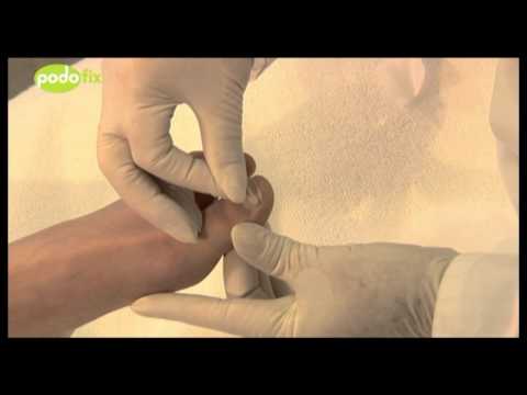 3TO Podofix Nail Brace Demonstration 