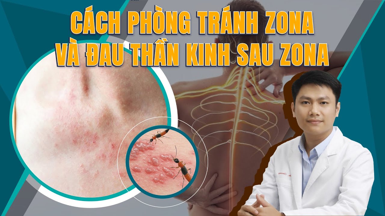 CÁCH ĐỂ KHÔNG MẮC ZONA VÀ ĐAU THẦN KINH SAU ZONA | Bác sĩ Trường