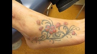 Laser Tattoo Removal  TriCities Med Spa in Kennewick