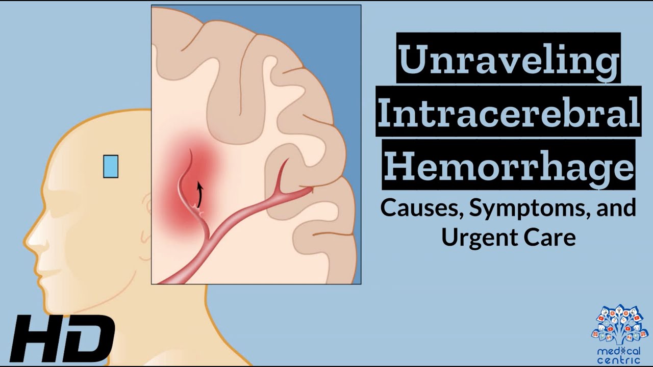 Intracerebral Hemorrhage Unveiled: Understanding the Whys, Whats