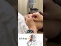 坐骨神経痛はこうやって回復させます#鍼治療 #治し方 #ゴットハンド