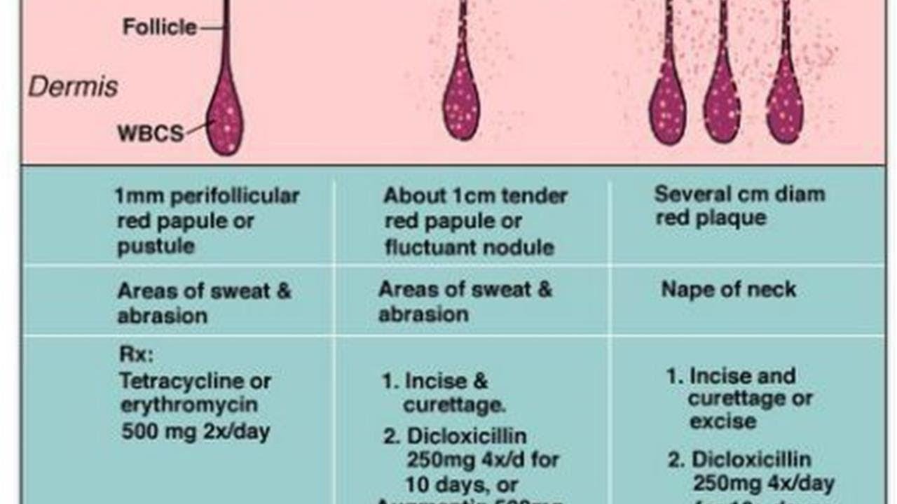 What’s the Difference Between a Furuncle and a Carbuncle? Tita TV