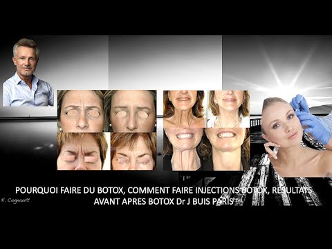 Vidéo: Vais-je recevoir du botox lors de ma consultation ?