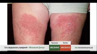 видео Кожная сыпь при аллергии и ее лечение