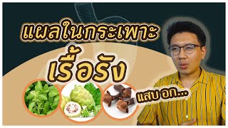 รักษาแผลในกระเพาะอาหาร เรื้อรัง - หมอนัท