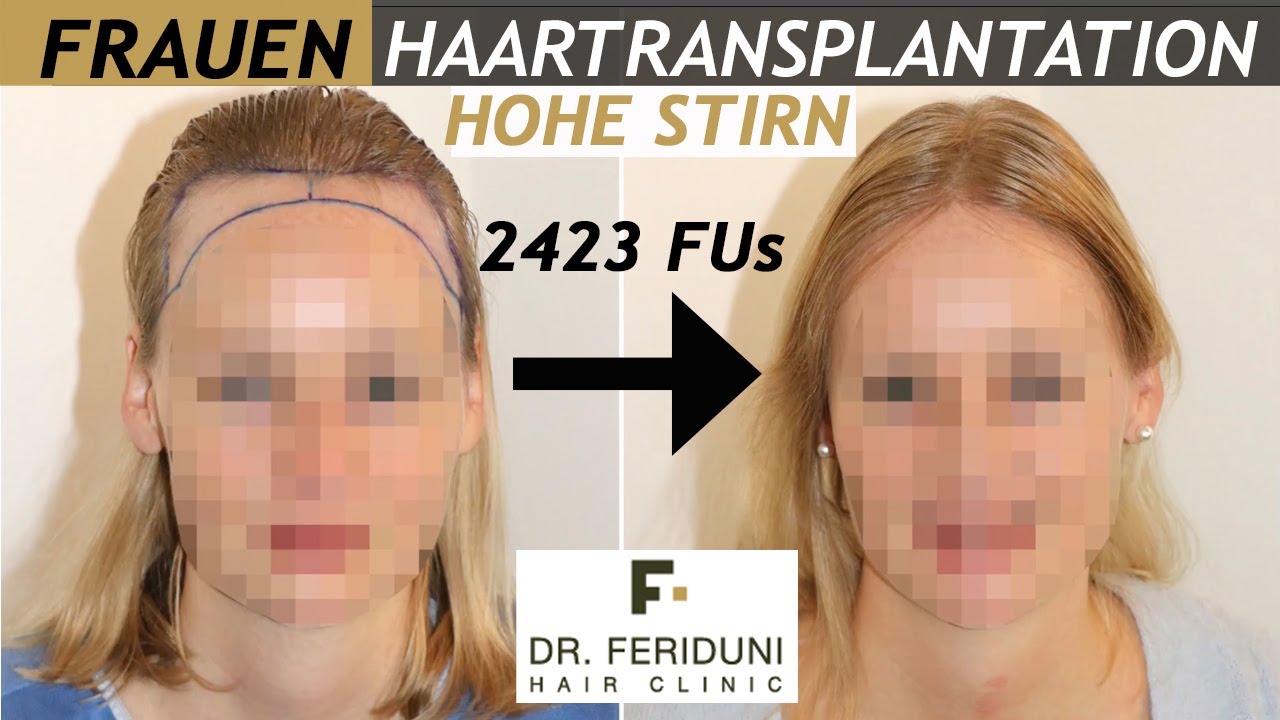 haartransplantation-frauen-hohe-stirn-u-geheimratsecken-fue
