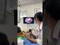 耳垢そうじ/耳が痒くなった鼓膜に付着した軟耳垢/#shorts