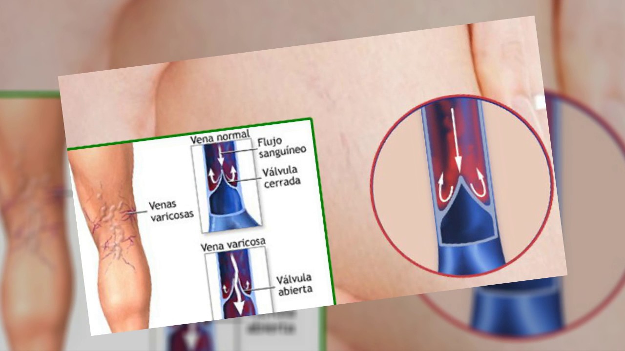 Varikosette opiniones: Comentarios, Precio, Donde comprar en farmacias, España