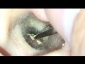 내 조카 의 귀지 Cerumen de mi sobrino My nephew's earwax cứt ráy ขี้หู หลานชาย ของฉัน 甥っ子の耳あかとってみました