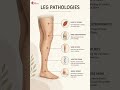 Leg Pathologies 🦵 |