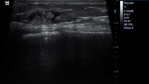 US guided block of the Infrapatellar branch of the Saphenous nerve.