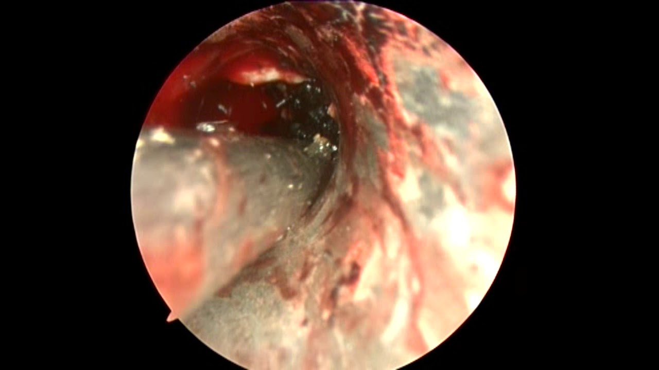 грибы верхнечелюстной пазухи