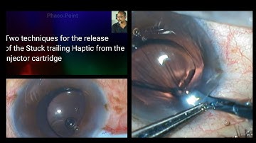 Two Sure fire techniques to release the stuck trailing Haptic from the injector cartridge